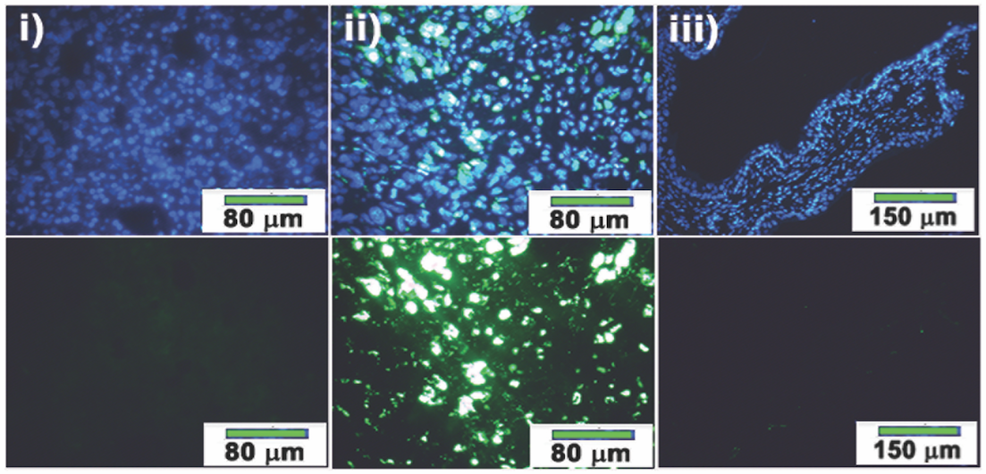 Targeted ovarian cancer cells glow green